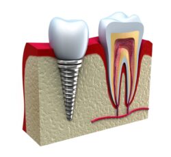 Anatomy of healthy teeth and dental implant in jaw bone