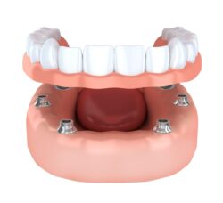 All on Four dental implants in plano tx