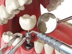 dental implant procedure cost in plano, texas