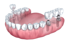 dental implant bridge in Plano Texas