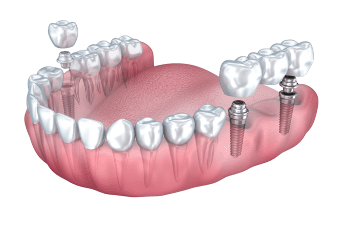 dental implant-supported crown and bridge in Plano, TX