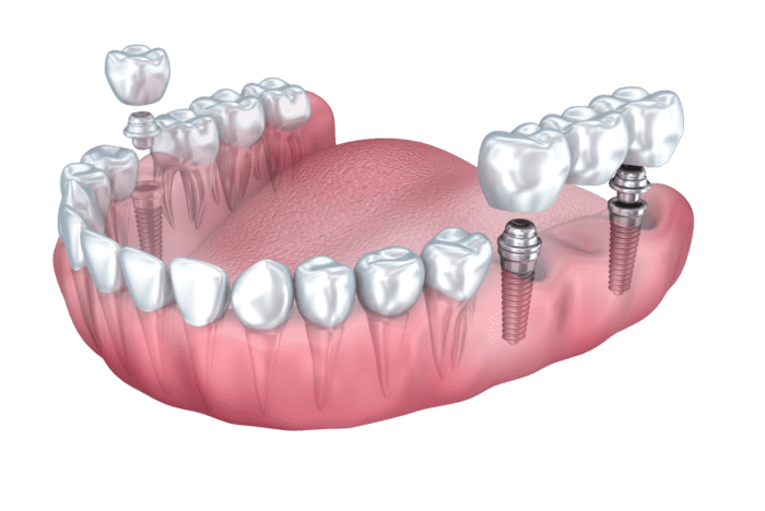 dental implant bridge in Dallas, TX