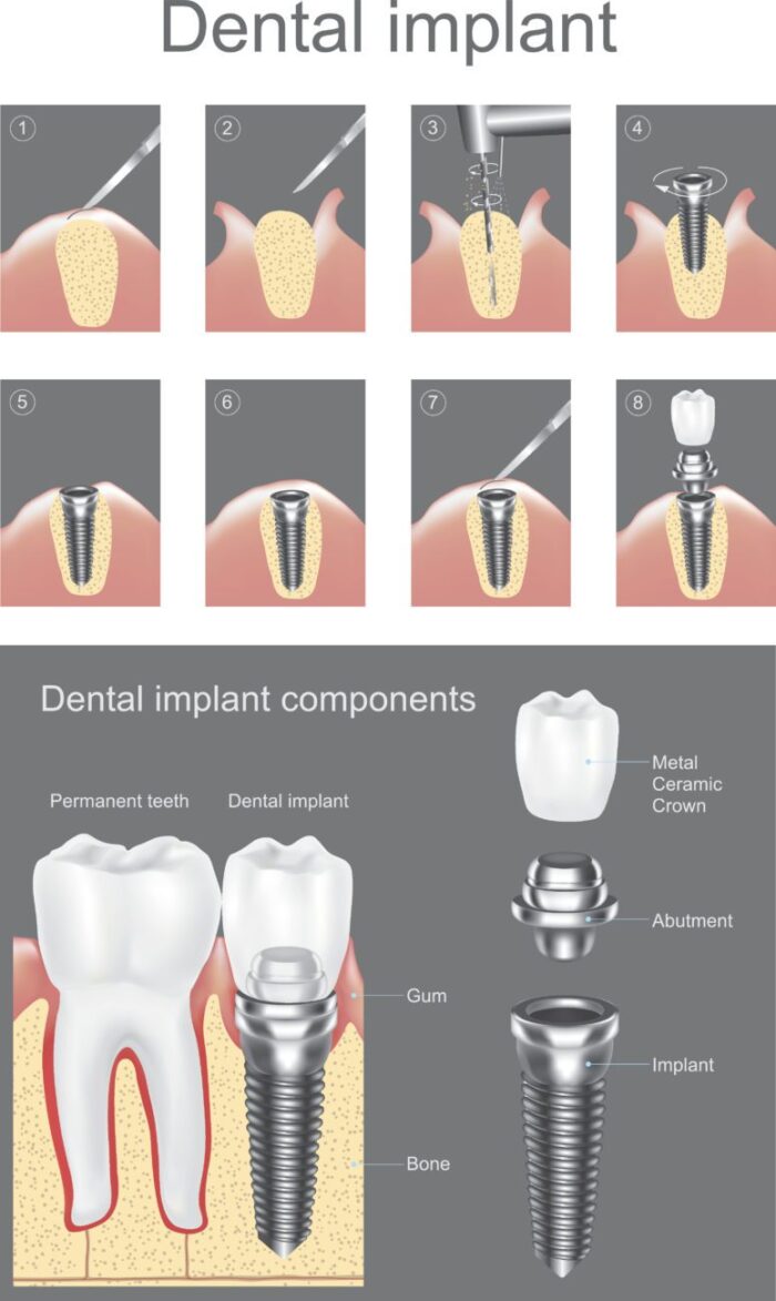 Dental Implants Process Plano TX Teeth Implants Dallas