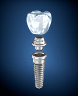 single dental implant for a missing tooth in plano, texas