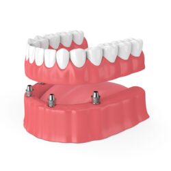 implant dentures to replace a full row of teeth in plano, texas