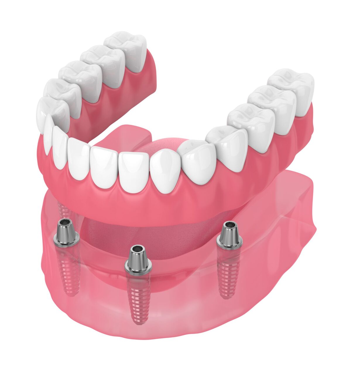 all-on-four dental implants in Plano Texas