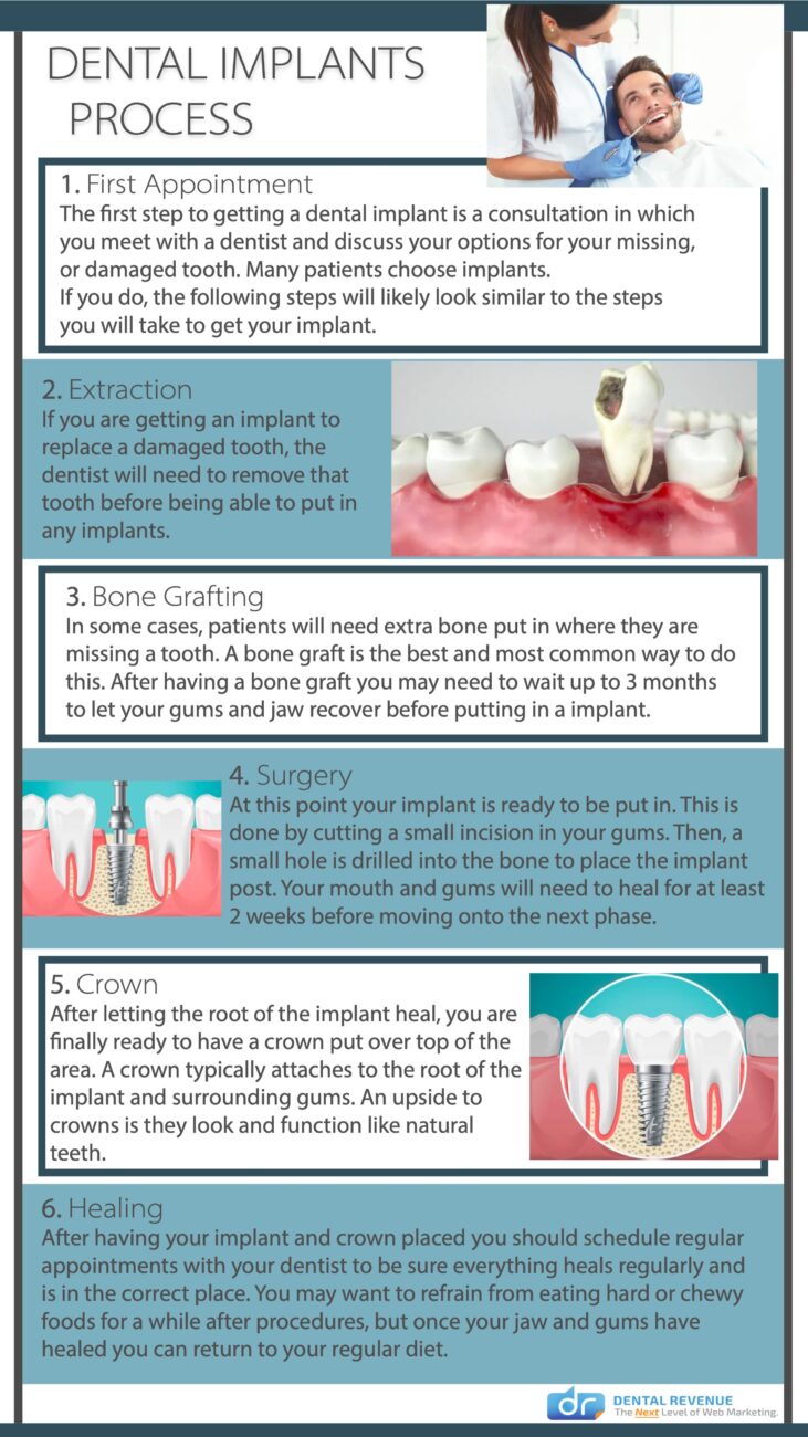 dental implant process infographic