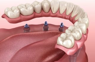 implant dentures in Plano Texas