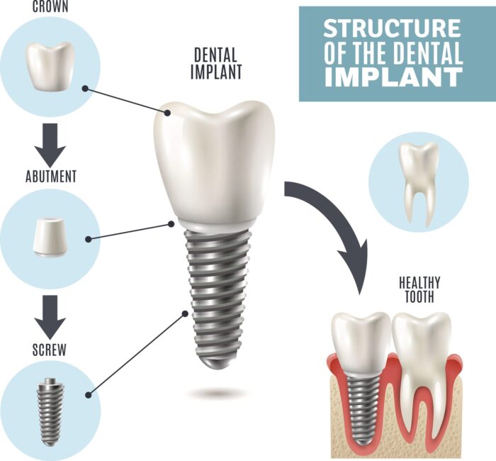 Dental Implant Structure