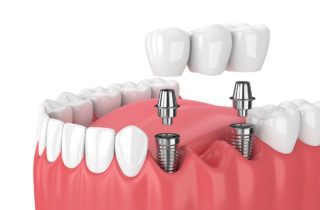 types of dental bridges Plano Texas