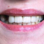 Can Sugar Cause Tooth Loss