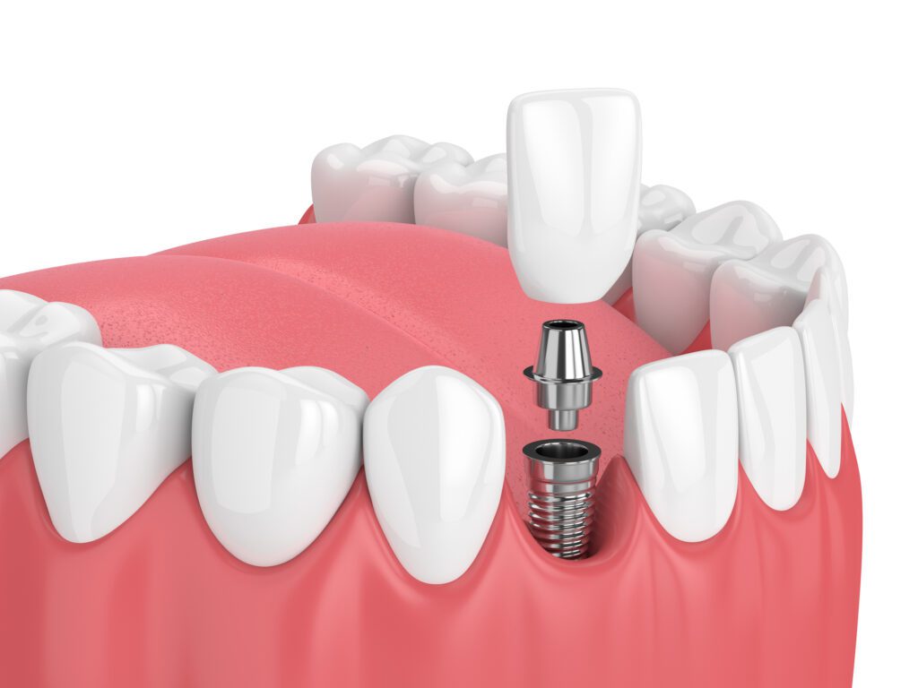 Dental implants in Dallas, TX