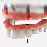 Understanding the all-on-four process can help patients feel more comfortable and informed about their upcoming dental treatments.